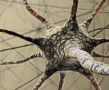 Haemorrhagic Stroke